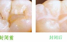 小姐姐做牙窝沟封闭图片,小姐姐的护齿日记